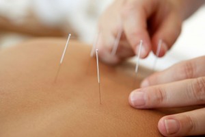 Akupunktur-hilft-gegen-chronische-Rueckenschmerzen